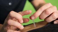 patient receiving acupuncture